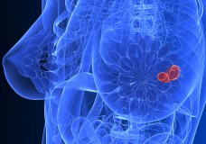 How Cannabis Fights Breast Cancer